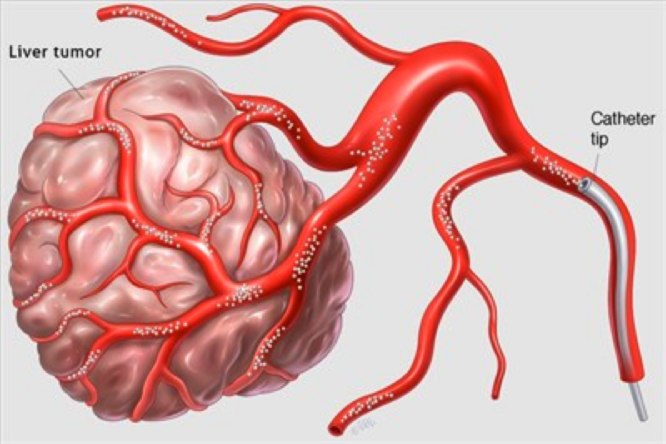 Quimioembolización transarterial.