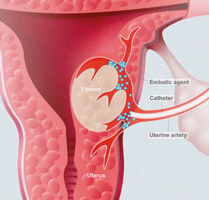 Nuevo tratamiento para los miomas uterinos.